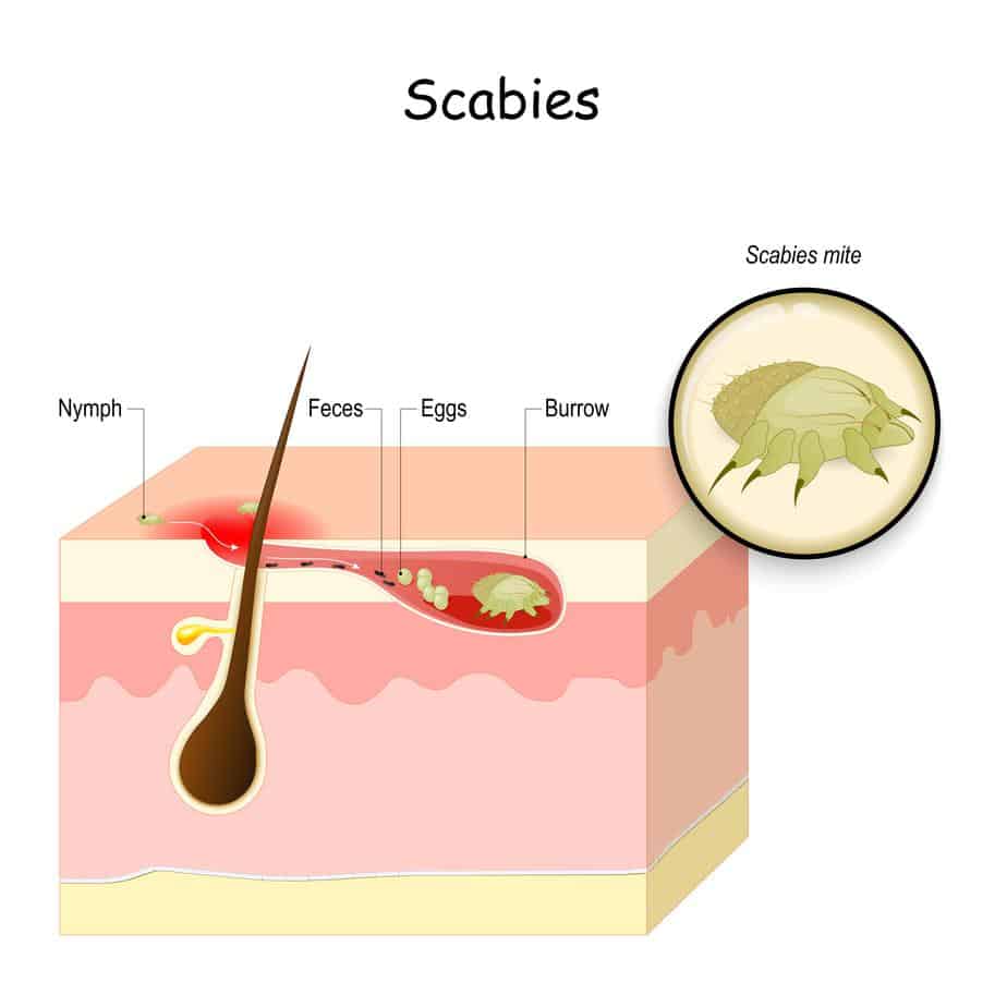 scabies mite burrowing near a hair shaft