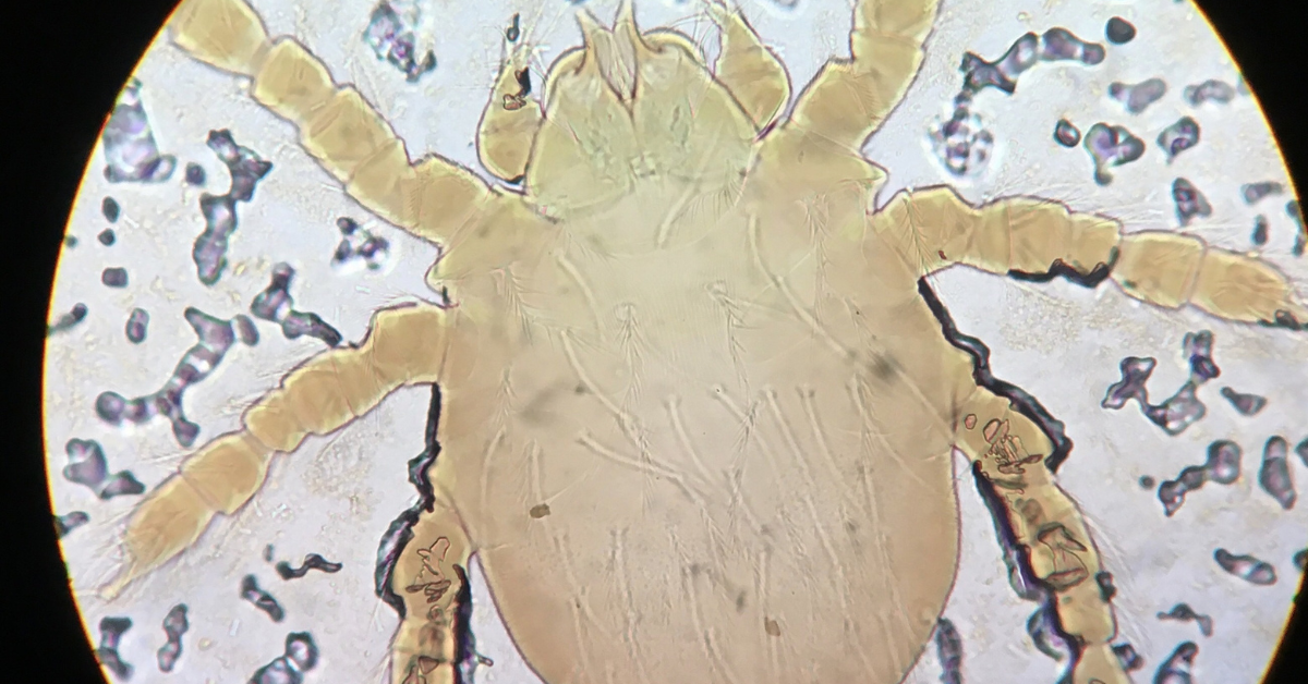 Chiggers in Bed Here's What You Need to Know